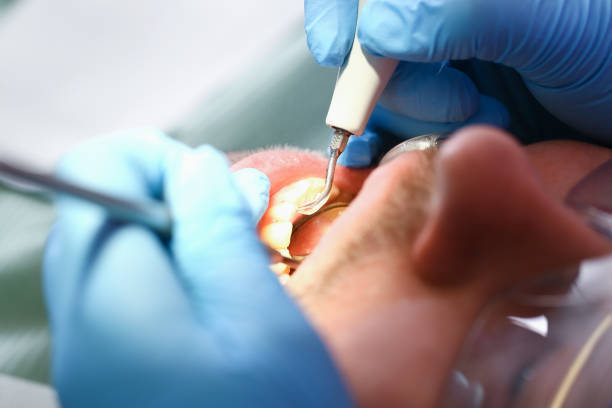 Best Emergency Treatment for Dental Infections or Abscesses in Calhoun, GA